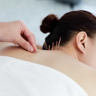 Acupuncture treatment using fine needles in Flushing, NY